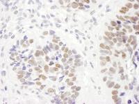 Detection of human MSH6 by immunohistoch