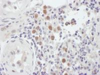 Detection of human MSH6 by immunohistoch
