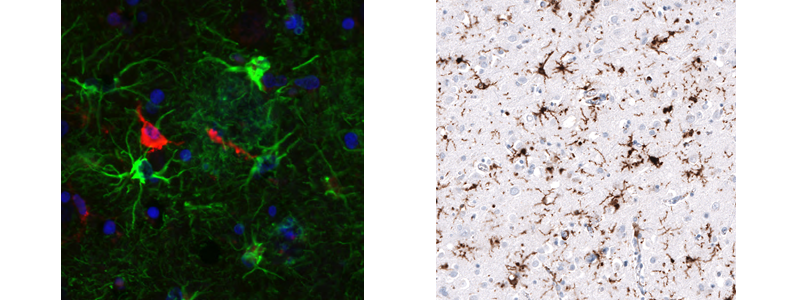 Anti-HLA-DRA (AMAb91674) shows microglial cells in red. Anti-GFAP (AMAb91033) shows astrocytes in green in Alzheimer’s disease cerebral cortex.