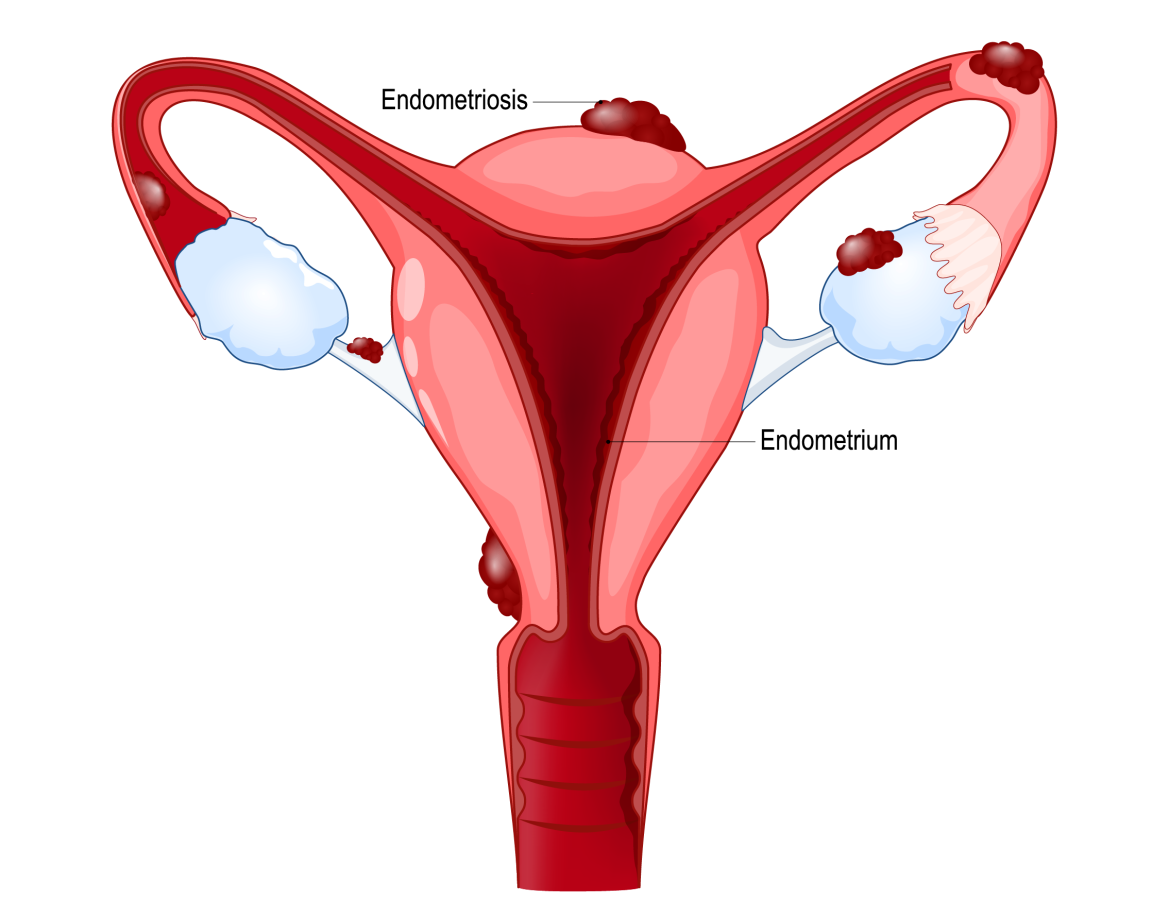 endometriosis