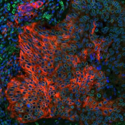 Detection of human PD-L1 (red) and Lamin-A/C (green) in FFPE lung carcinoma by IHC-IF