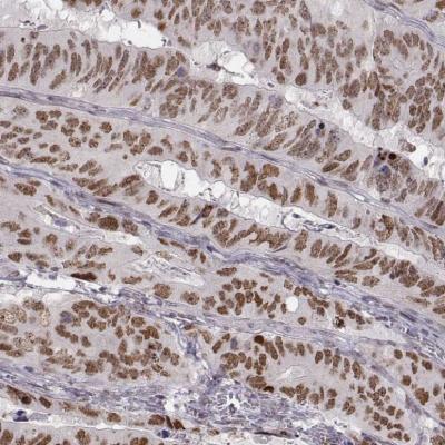 Colorectal cancer staining